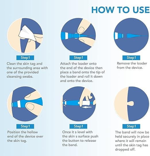 2-in-1 Skin Tag Remover Kit – Painless Auto Wart Removal Pen with Cleansing Wipes & Rubber Bands