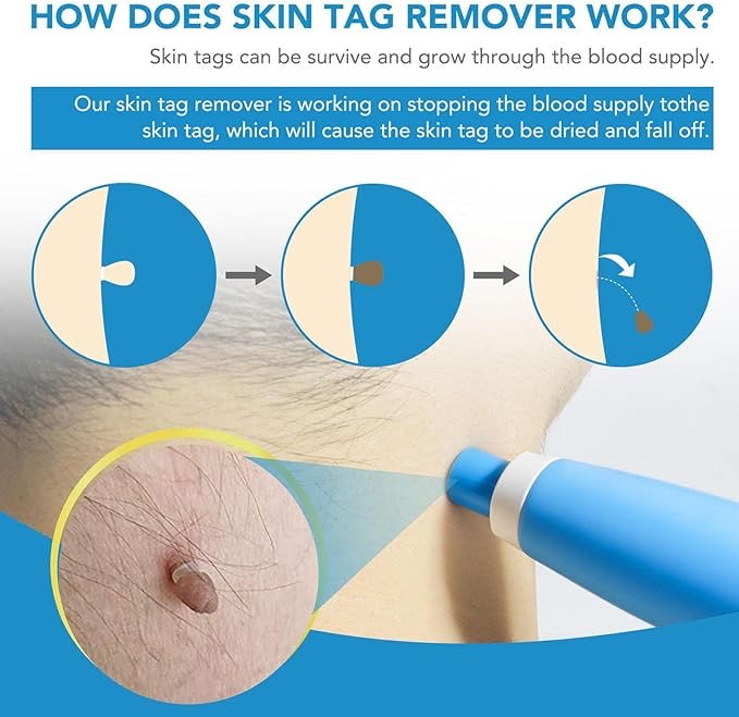 2-in-1 Skin Tag Remover Kit – Painless Auto Wart Removal Pen with Cleansing Wipes & Rubber Bands