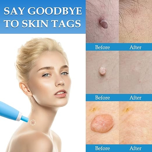 2-in-1 Skin Tag Remover Kit – Painless Auto Wart Removal Pen with Cleansing Wipes & Rubber Bands