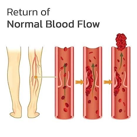 Varicose Veins Patches Skin-Friendly Non-Toxic
Improve Varicosity Dredge Vein Relieve Soothe Swelling Pain - 10 pcs pack