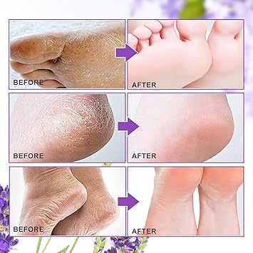 Foot Peel Mask For Dead Skin Removal Dry Cracked Callus Remover Hydrating Sock Deeply
Moisturizes Dry & Dull Skin Reduces Pigmentation- Goat
Milk Essence