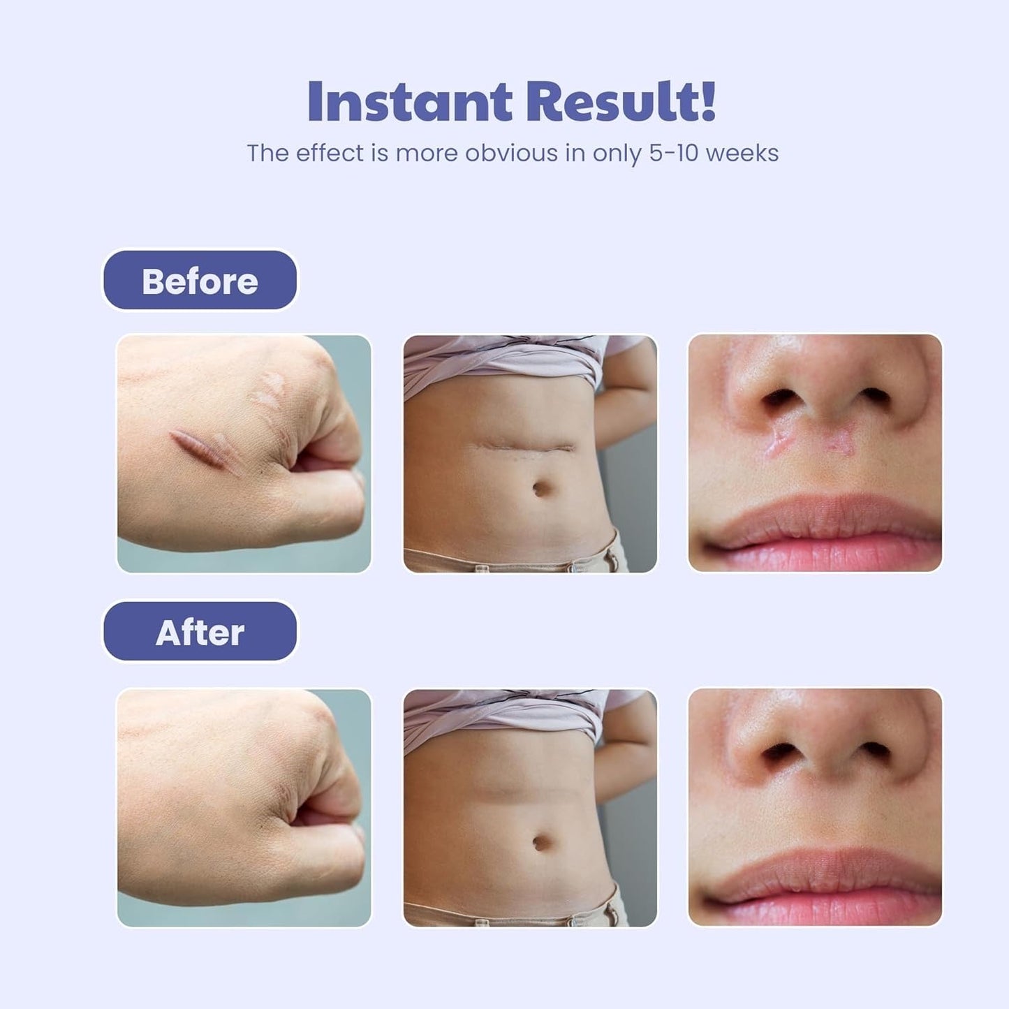 Silicone Scar Sheets, Silicon gel sheets for Scars Transparent Medical Silicone Tape for Scar Removal